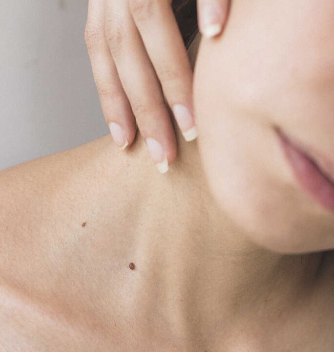 Sztywność szyi jest jednym z objawów początkowego stadium osteochondrozy odcinka szyjnego kręgosłupa