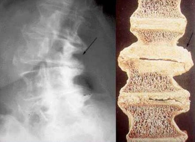 uszkodzenie kręgów w osteochondrozie klatki piersiowej