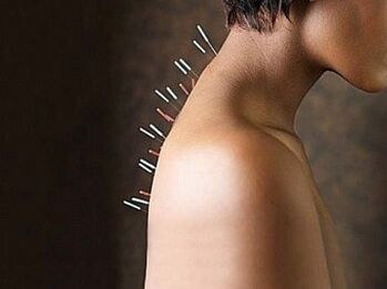 Refleksoterapia jest skuteczną metodą leczenia osteochondrozy szyjnej